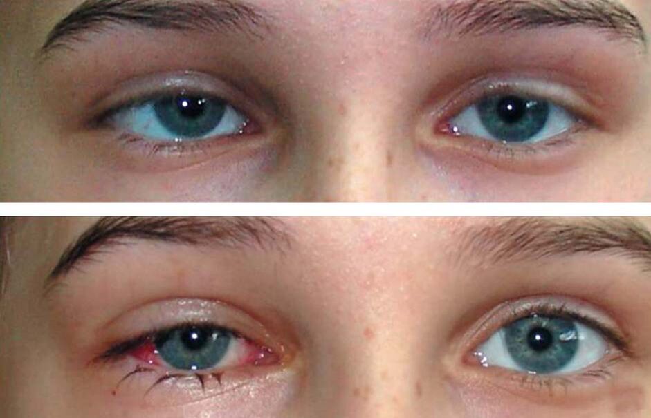 Oculax before and after treatment