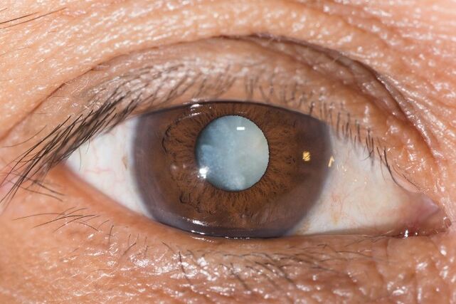 For cataracts, exercises to improve vision are recommended.