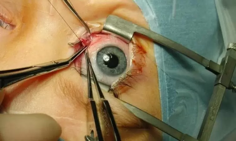 Using eyelid expanders for eye surgery