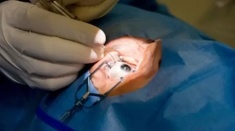 Vitrectomy – removal of the vitreous humor from the eye